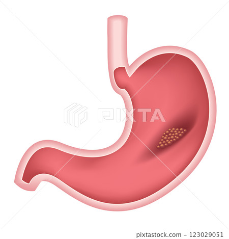 Gastric Cancer. Stomach tumor in the digestive system  123029051