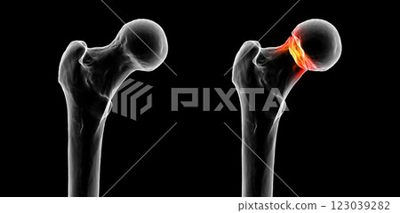 Subcapital femur fracture, 3D illustration 123039282