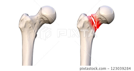 Transcervical femur fracture, 3D illustration Transcervical femur fracture, 3D illustration 123039284