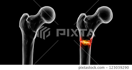 Subtrochanteric femur fracture, 3D illustration Subtrochanteric femur fracture, 3D illustration 123039290