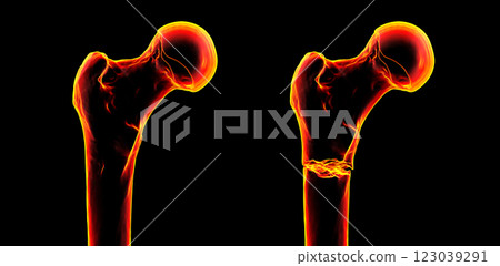 Subtrochanteric femur fracture, 3D illustration Subtrochanteric femur fracture, 3D illustration 123039291