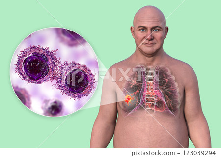 Lung cancer, 3D illustration 123039294