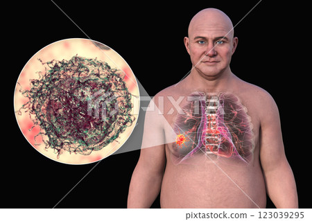 Lung cancer, 3D illustration 123039295