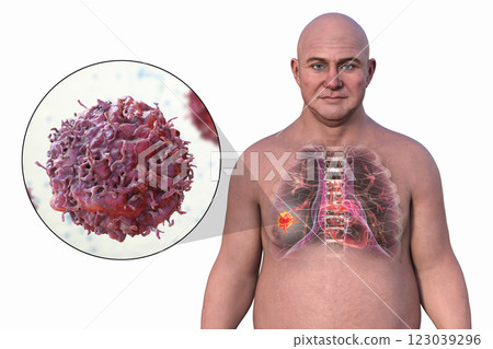 Lung cancer, 3D illustration 123039296