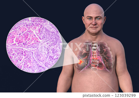Lung cancer, 3D illustration and light micrograph Lung cancer, 3D illustration and light micrograph 123039299