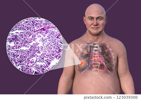 Lung cancer, 3D illustration and light micrograph Lung cancer, 3D illustration and light micrograph 123039300