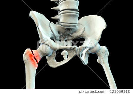 Basicervical femur fracture, 3D illustration Basicervical femur fracture, 3D illustration 123039318