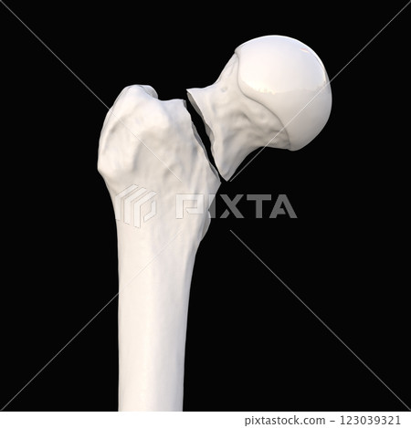 Transcervical femur fracture, 3D illustration 123039321