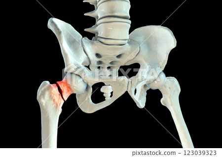 Transcervical femur fracture, 3D illustration 123039323
