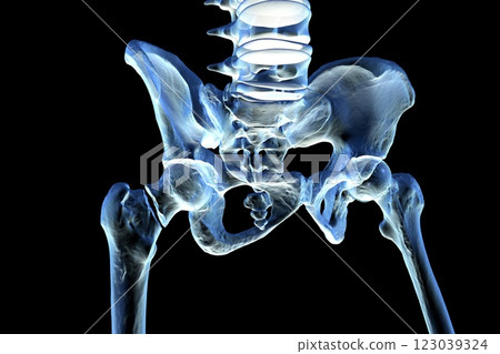 Transcervical femur fracture, 3D illustration Transcervical femur fracture, 3D illustration 123039324