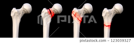 Femur fracture types: normal femur, femoral neck fracture, intertrochanteric fracture, and subtrochanteric fracture, 3D illustration. Femur fracture types: normal femur, femoral neck fracture, intertrochanteric fracture, and subtrochanteric fracture, 3D illustration. 123039327
