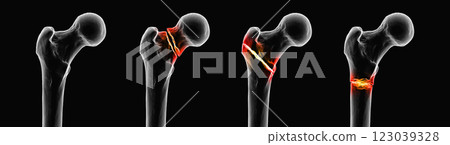 Femur fracture types: normal femur, femoral neck fracture, intertrochanteric fracture, and subtrochanteric fracture, 3D illustration. 123039328