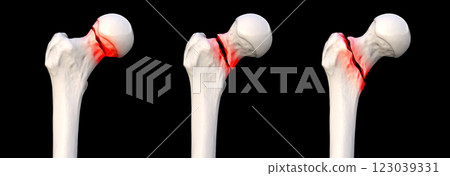 Femur neck fracture types: subcapital, transcervical, and basicervical, 3D illustration Femur neck fracture types: subcapital, transcervical, and basicervical, 3D illustration 123039331