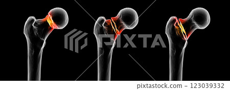 Femur neck fracture types: subcapital, transcervical, and basicervical, 3D illustration 123039332