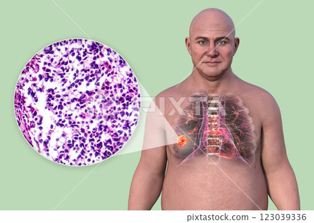 Lung cancer, 3D illustration and light micrograph 123039336