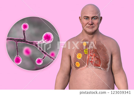 Human lungs affected by blastomycosis, 3D illustration 123039341