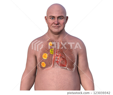Human lungs affected by blastomycosis, 3D illustration Human lungs affected by blastomycosis, 3D illustration 123039342