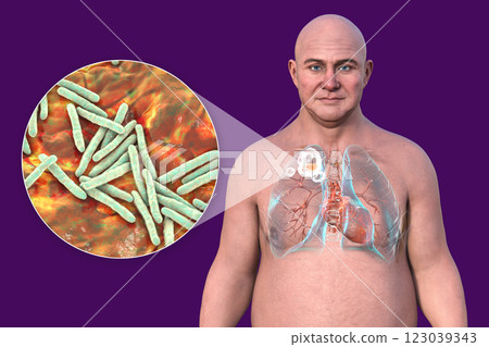 Cavitary tuberculosis, 3D illustration Cavitary tuberculosis, 3D illustration 123039343