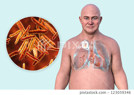 Cavitary tuberculosis, 3D illustration Cavitary tuberculosis, 3D illustration 123039346