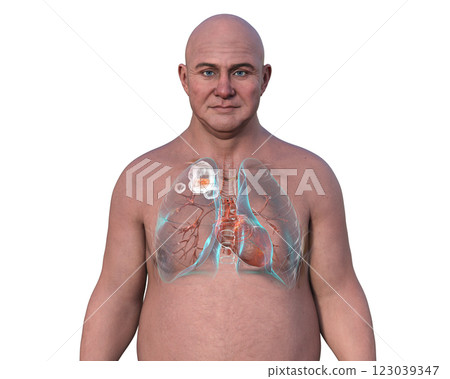 Cavitary tuberculosis, 3D illustration 123039347