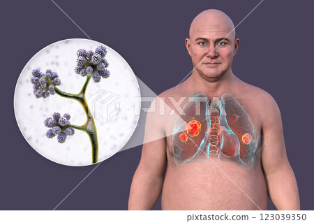 Lung mucormycosis and close-up view of Cunninghamella fungi, 3D illustration Lung mucormycosis and close-up view of Cunninghamella fungi, 3D illustration 123039350