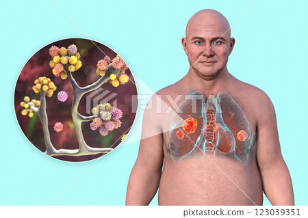 Lung mucormycosis and close-up view of Cunninghamella fungi, 3D illustration 123039351