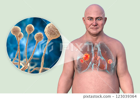 Lung mucormycosis and close-up view of Mucor fungi, 3D illustration Lung mucormycosis and close-up view of Mucor fungi, 3D illustration 123039364