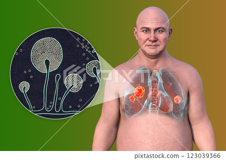 Lung mucormycosis and close-up view of Mucor fungi, 3D illustration 123039366