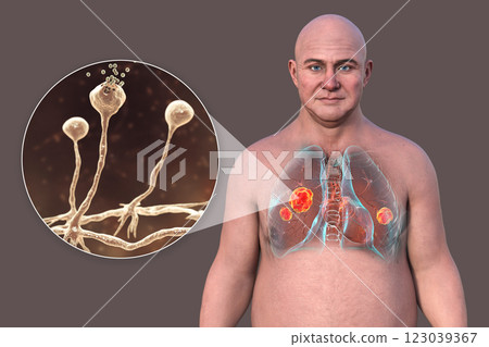 Lung mucormycosis and close-up view of Rhizopus fungi, 3D illustration 123039367