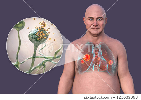 Lung mucormycosis and close-up view of Rhizopus fungi, 3D illustration 123039368