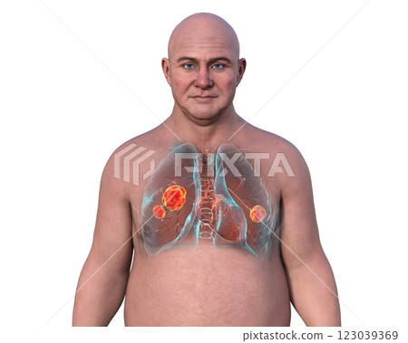 Lung mucormycosis, 3D illustration 123039369