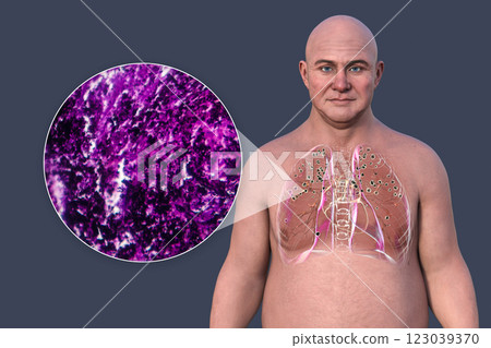 Man with silicosis, 3D illustration and light micrograph 123039370