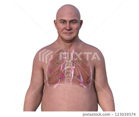 Man with silicosis, 3D illustration 123039374