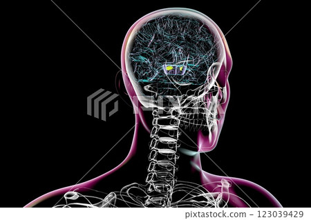 Atrophic substantia nigra in Parkinson's disease, 3D illustration 123039429