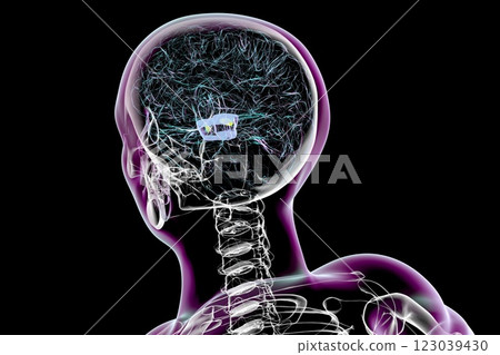 Atrophic substantia nigra in Parkinson's disease, 3D illustration 123039430