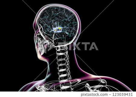Atrophic substantia nigra in Parkinson's disease, 3D illustration 123039431