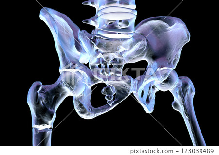 Subtrochanteric femur fracture, 3D illustration 123039489