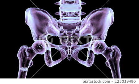 Subtrochanteric femur fracture, 3D illustration Subtrochanteric femur fracture, 3D illustration 123039490