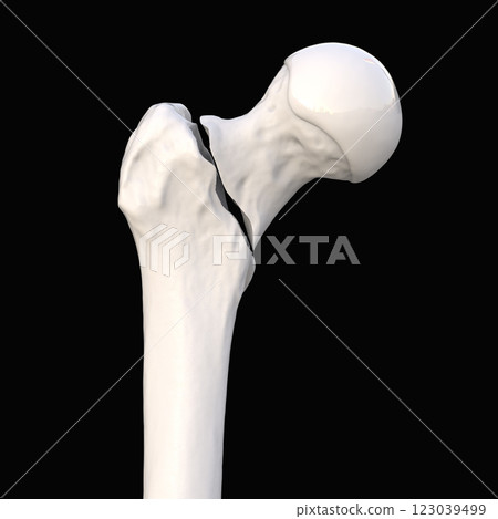 Basicervical femur fracture, 3D illustration 123039499