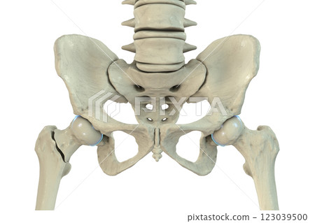 Basicervical femur fracture, 3D illustration 123039500