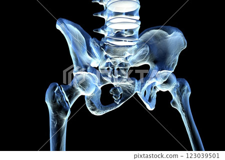 Basicervical femur fracture, 3D illustration 123039501