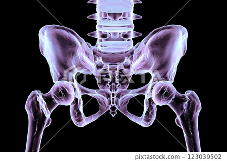 Basicervical femur fracture, 3D illustration 123039502