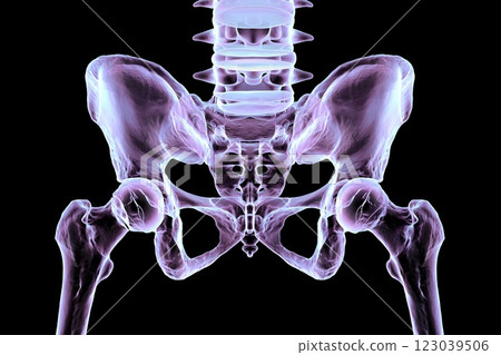 Subcapital femur fracture, 3D illustration Subcapital femur fracture, 3D illustration 123039506