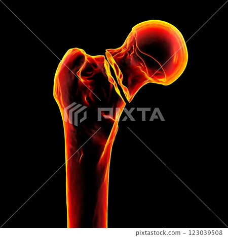 Transcervical femur fracture, 3D illustration Transcervical femur fracture, 3D illustration 123039508