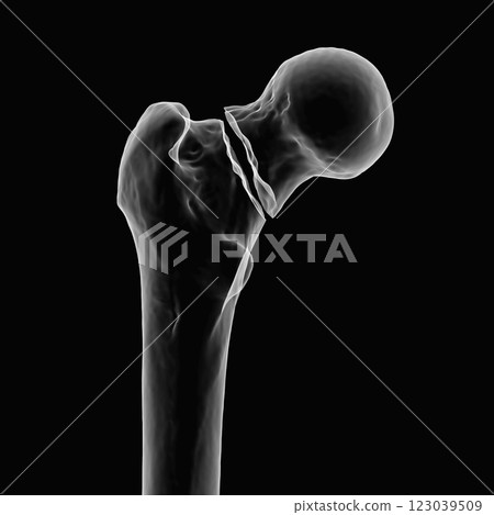 Transcervical femur fracture, 3D illustration Transcervical femur fracture, 3D illustration 123039509