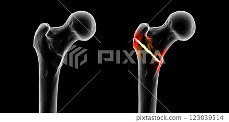 Intertrochanteric femur fracture, 3D illustration Intertrochanteric femur fracture, 3D illustration 123039514