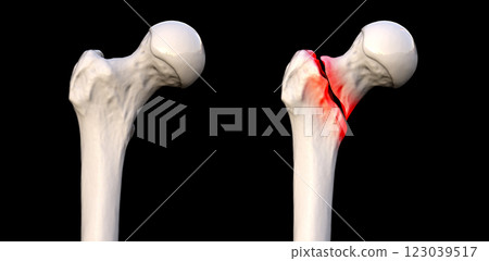 Basicervical femur fracture, 3D illustration Basicervical femur fracture, 3D illustration 123039517