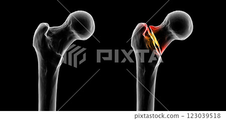 Basicervical femur fracture, 3D illustration 123039518