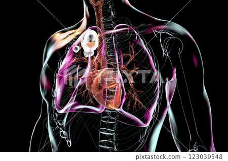 Cavitary tuberculosis, 3D illustration 123039548