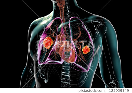 Lung mucormycosis, 3D illustration Lung mucormycosis, 3D illustration 123039549